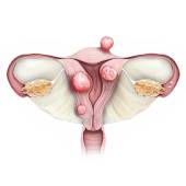 Fibroids